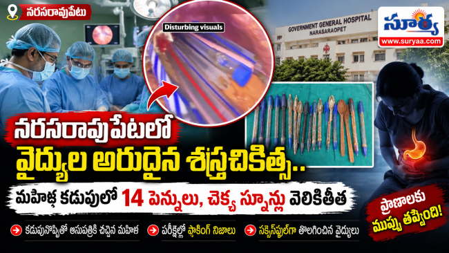 నరసరావుపేటలో వైద్యుల అరుదైన శస్త్రచికిత్స.. మహిళ కడుపులో 14 పెన్నులు, చెక్క స్పూన్లు వెలికితీత
