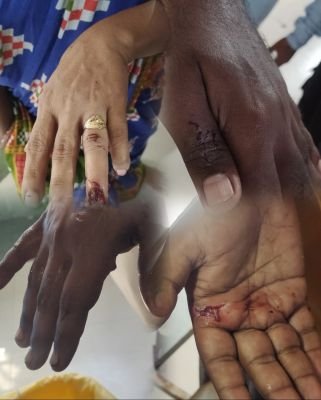 పిచ్చికుక్క సైర విహారం రెండేళ్ళ బాలుడితో సహా  ఆరుగురికి గాయాలు