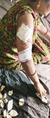 మహిళపై కోతి దాడి 60 కుట్టు