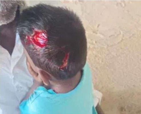 వీధి కుక్కల దాడిలో బాలుడికి తీవ్ర గాయాలు