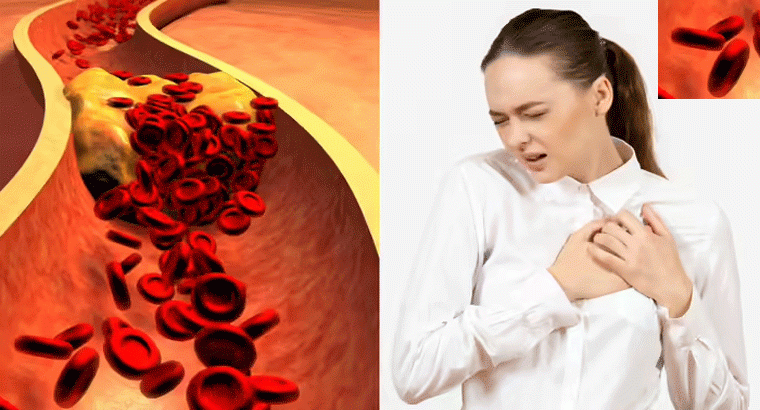 రోజు వారి ఫుడ్ మెను కారణంగా... కొలెస్ట్రాల్ పెరిగి గుండె సమస్యలు, స్ట్రోక్స్ వస్తే