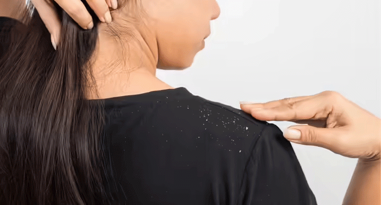 చలికాలంలో ఇబ్బంది పెట్టే చుండ్రుని పోగొట్టే చిట్కాలు