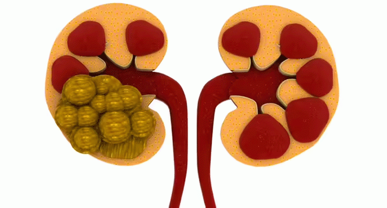 కిడ్నీలో రాళ్లను కరిగించి బయటకు పంపే డ్రింక్