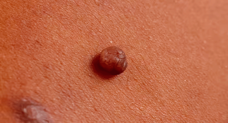  పులిపిర్లు తగ్గించే చిట్కాలు,,,,వాటంతట అవే రాలిపోతాయి