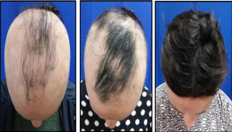 రోజుకు రెండు ట్యాబ్లెట్లతో జట్టు ఒత్తుగా...నిండుగా