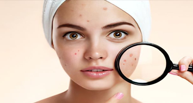 మొటిమల మచ్చలు పోవాలంటే!
