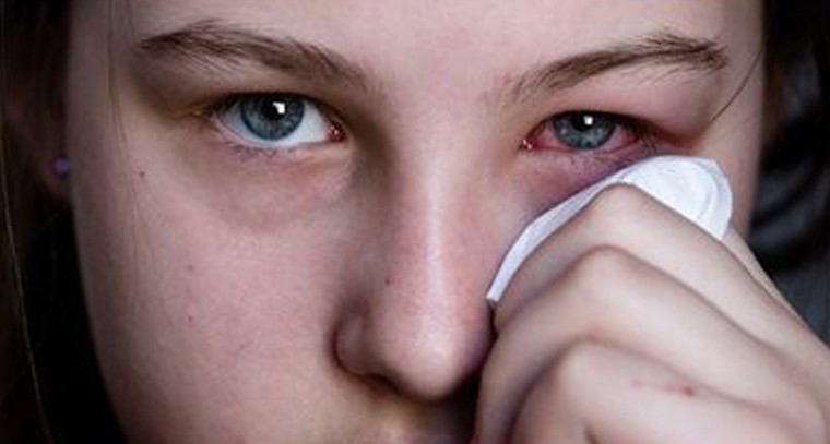 కళ్లు మంటలు ఉంటే పోగొట్టుకోండిలా
