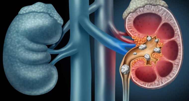 కిడ్నీలో రాళ్లు కరిగించుకోండిలా?
