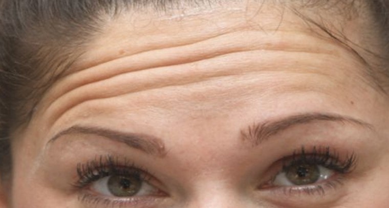 నుదుటిపై ముడతలకు చెక్ పెట్టండిలా
