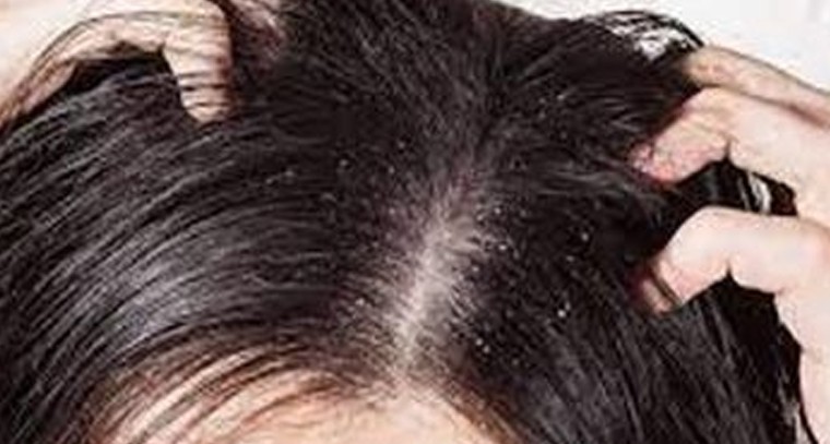 జుట్టు జిడ్డుగా మారుతోందా? ఇలా చేయండి
