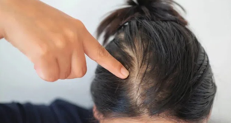 జుట్టు పల్చబడటానికి కారణాలివే!
