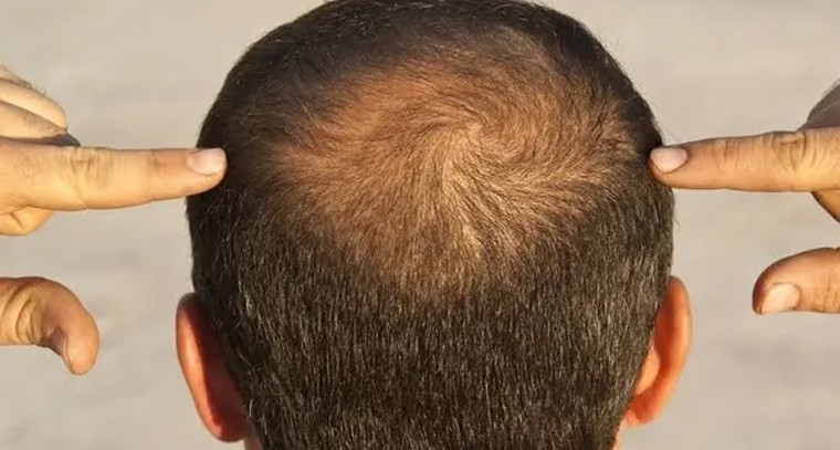 వారికి బట్టతల త్వరగా వచ్చేస్తుందా.?
