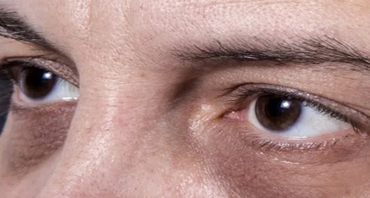 కళ్ల కింద వలయాలు తగ్గించే చిట్కాలివే.!
