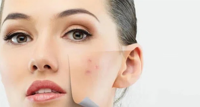 మెుటిమలు, మచ్చలకు ఇలా చెక్ పెట్టండి
