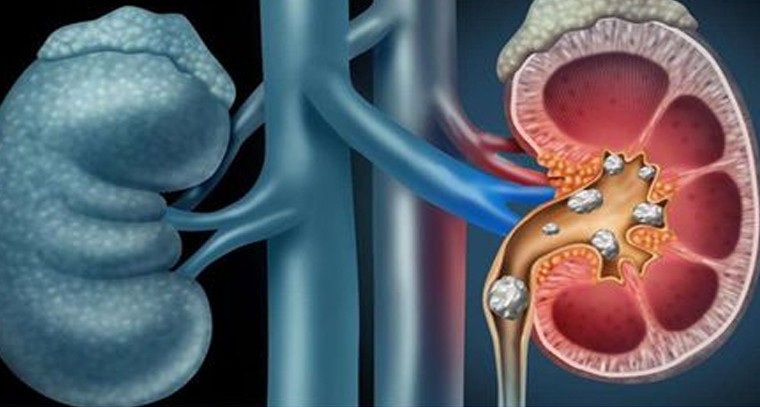 కిడ్నీల్లో రాళ్ల సమస్యకు చెక్ పెట్టండిలా

