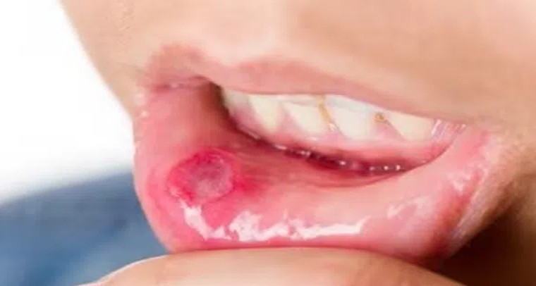 నోటిపూతను నివారించే చిట్కాలివే!
