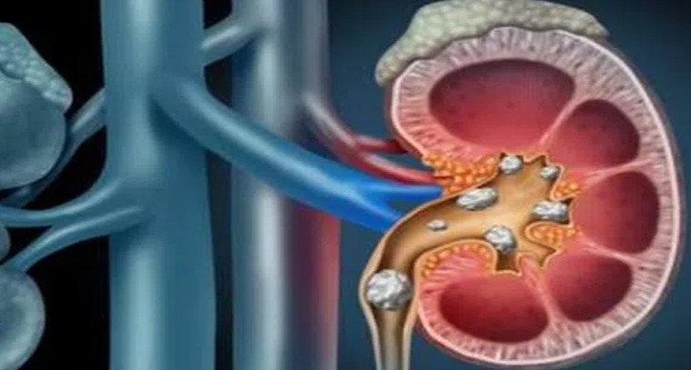 కిడ్నీలో రాళ్లు.. లక్షణాలివే!
