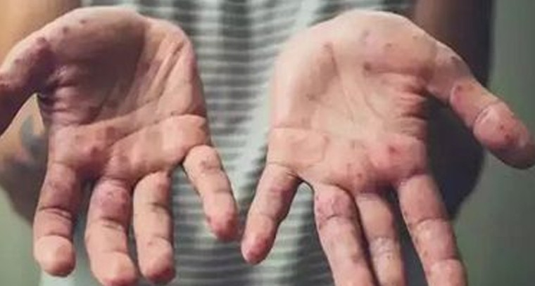 మంకీపాక్స్ లక్షణాలుంటే ఇలా చేయొద్దు
