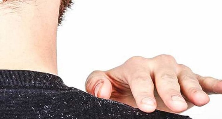 చుండ్రును తగ్గించుకోండిలా
