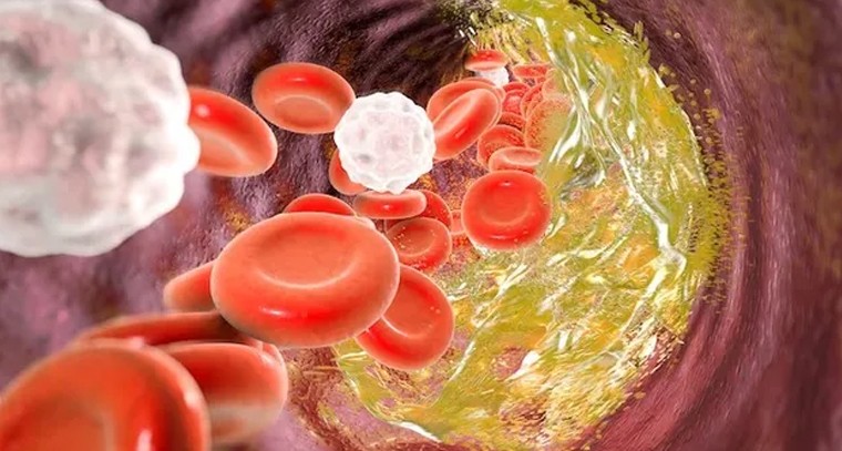 అధిక కొలెస్ట్రాల్ నివారణకు చ‌క్క‌టి చిట్కా
