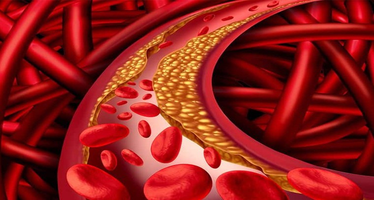 అధిక కొలెస్ట్రాల్ ఉందని చెప్పే సంకేతాలు ఇవే..
