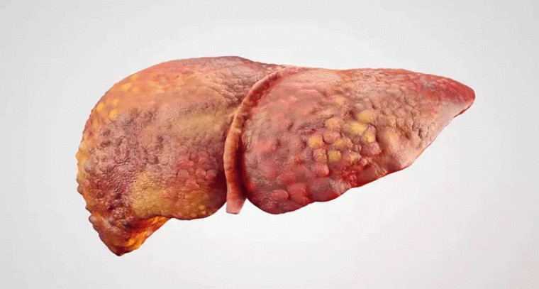 లివర్‌ సిర్రోసిస్‌ ఎందుకు వస్తుందో తెలుసా?
