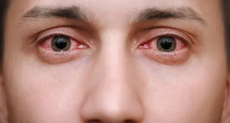 కళ్లు మంటను పొగొట్టుకోండిలా!
