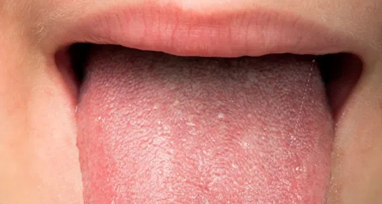 నాలుకపై పుట్టుమచ్చ ఉంటే అదృష్టమా?
