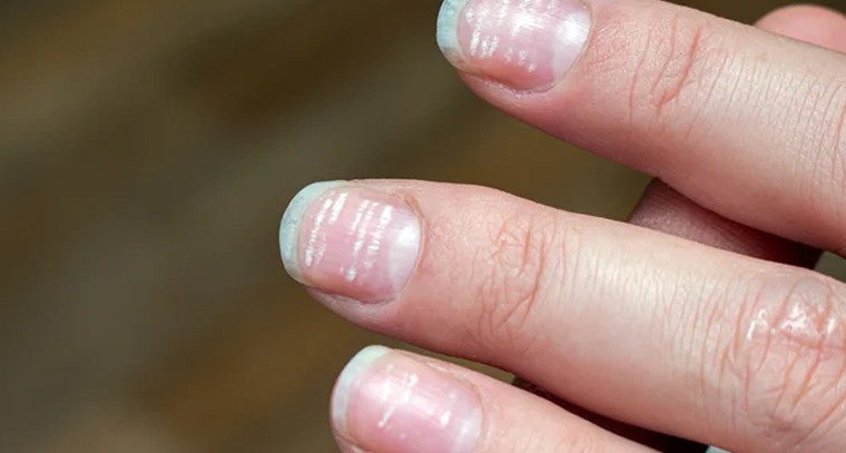 గోళ్లపైన తెల్లటి మచ్చలున్నాయా?
