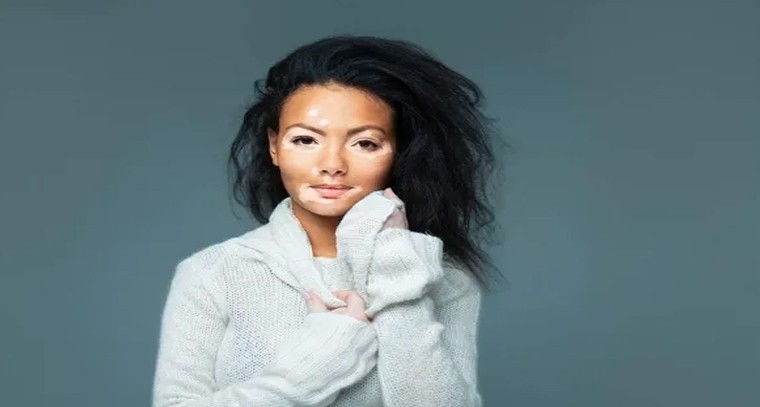 ముఖంపై తెల్లటి మచ్చలు వస్తున్నాయా?
