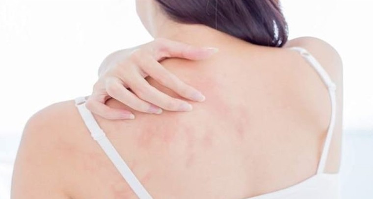 చెమటకాయలు తగ్గించుకోండిలా
