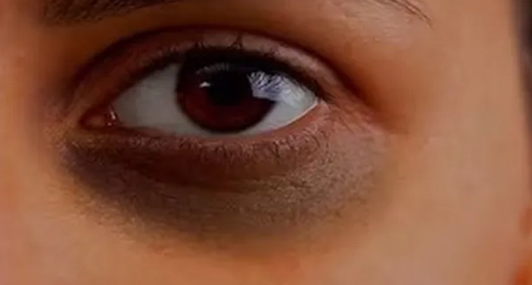 కంటి కింద నల్లటి వలయాలు పోవాలంటే.. ఇలా చేయండి
