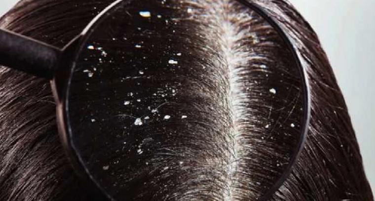 చుండ్రు సమస్యను అరికట్టండిలా..!
