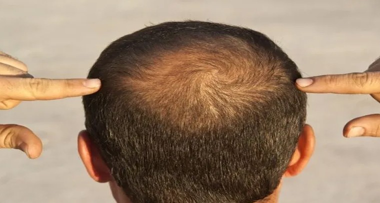 మగాళ్లకు బట్టతల ఇందుకే వస్తుందా..?
