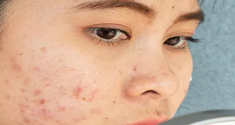 ఆయిల్ ఫుడ్‌ తింటే మొటిమలొస్తాయా..?
