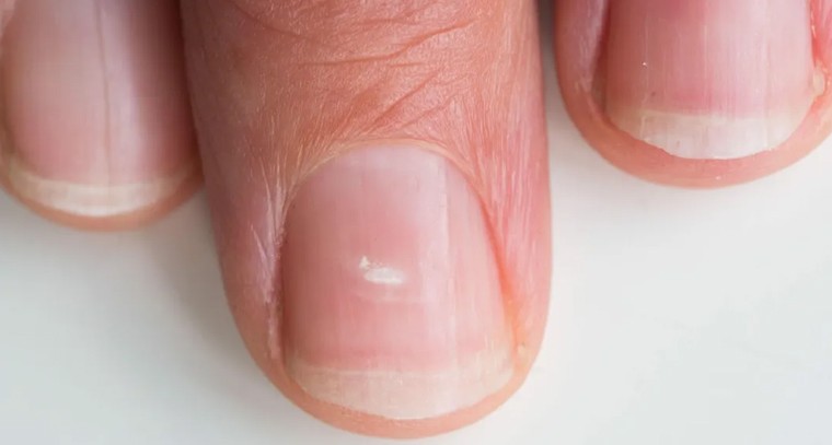 గోళ్లపైన తెల్లటి మచ్చలున్నాయా?
