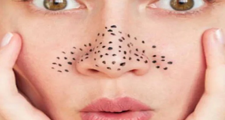ముక్కుపై నల్ల మచ్చలను తగ్గించే టిప్స్ ఇవే..!
