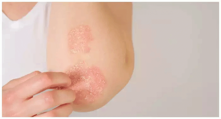 సోరియాసిస్‌ని తగ్గించే కొబ్బరినూనె, ఎలా వాడితే సమస్య తగ్గుతుందంటే