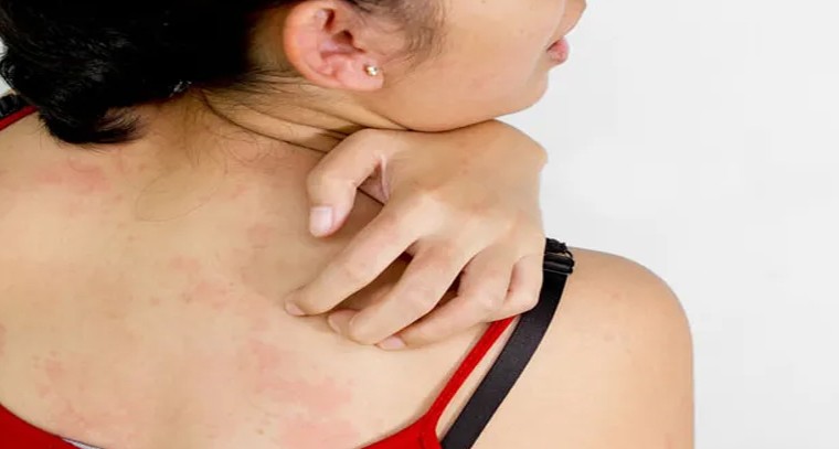 వర్షాకాలంలో స్కిన్ అలర్జీలు రాకుండా ఉండాలంటే ఇలా చేయండి!
