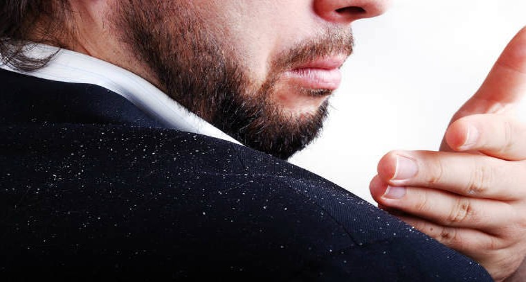 చుండ్రు సమస్య తగ్గించుకోండిలా?