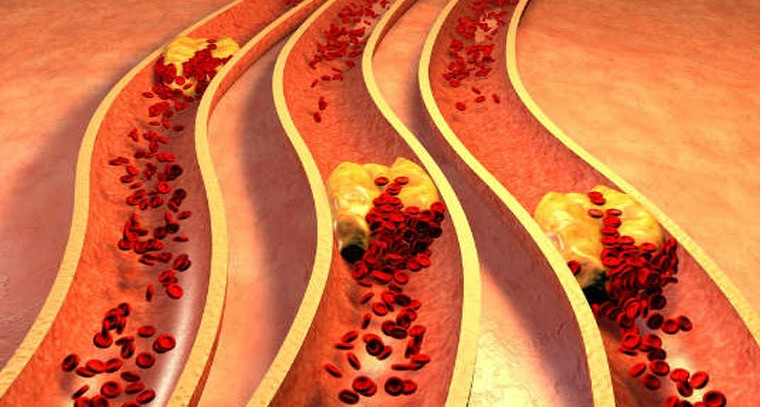 చెడు కొలెస్ట్రాల్‌ను ఇలా తగ్గించుకోండి
