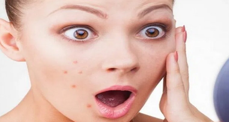 మొటిమలు రాకూడదంటే ఇలా చేయండి
