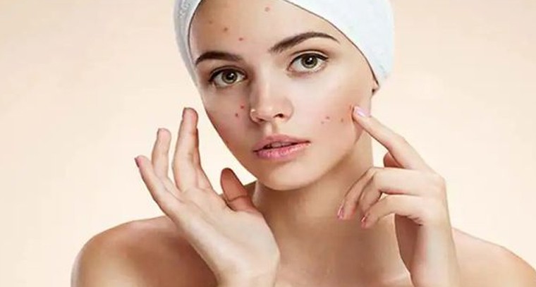 మొటిమలు తగ్గాలంటే ఇలా చేయండి
