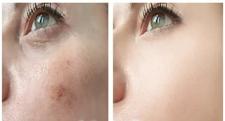 ఎలాంటి మంగు మచ్చల్ని అయినా మాయం చేసే ఫేస్‌ప్యాక్స్, రెగ్యులర్‌గా అప్లై చేస్తే ఫేస్‌ మెరుస్తుంది