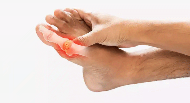 పెరిగిన యూరిక్ యాసిడ్‌ను మందులతో కాకుండా సహజంగా తగ్గించుకోవచ్చు