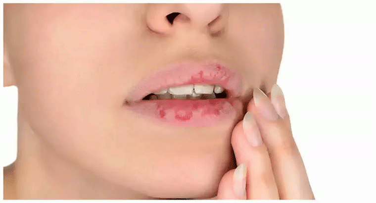 వీటితో పెదాల పగుళ్లు దూరమై ఎర్రగా మారతాయి