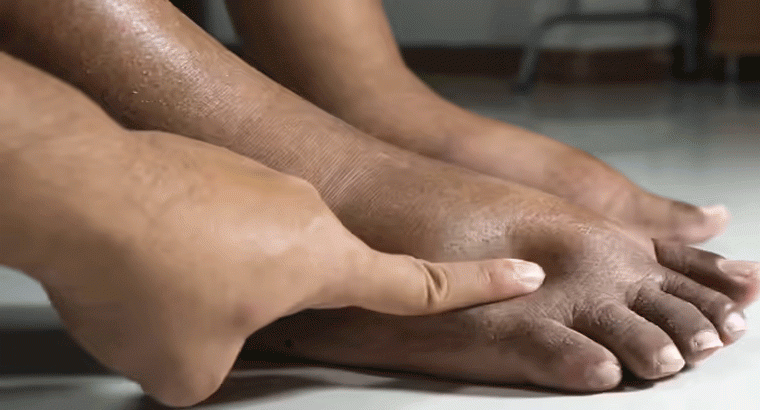 పాదాల వాపులు తిమ్మిర్లు ఉంటే మీ అనారోగ్యానికి సంకేతం