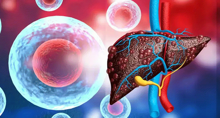 కాలేయంలో నీరు చేరితే శరీరంలో కనిపించే కొన్ని లక్షణాలు