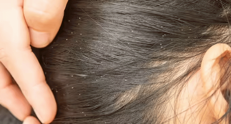 తలలో పేలు పోగొట్టే సులభమైన చిట్కా