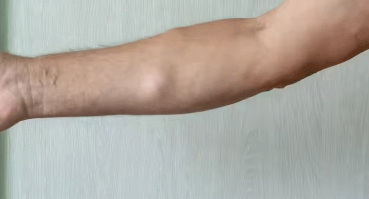 కొవ్వు గడ్డలు తగ్గేందుకు సింపుల్ చిట్కా